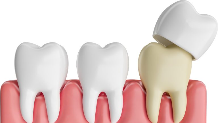 how-long-does-a-dental-crown-last