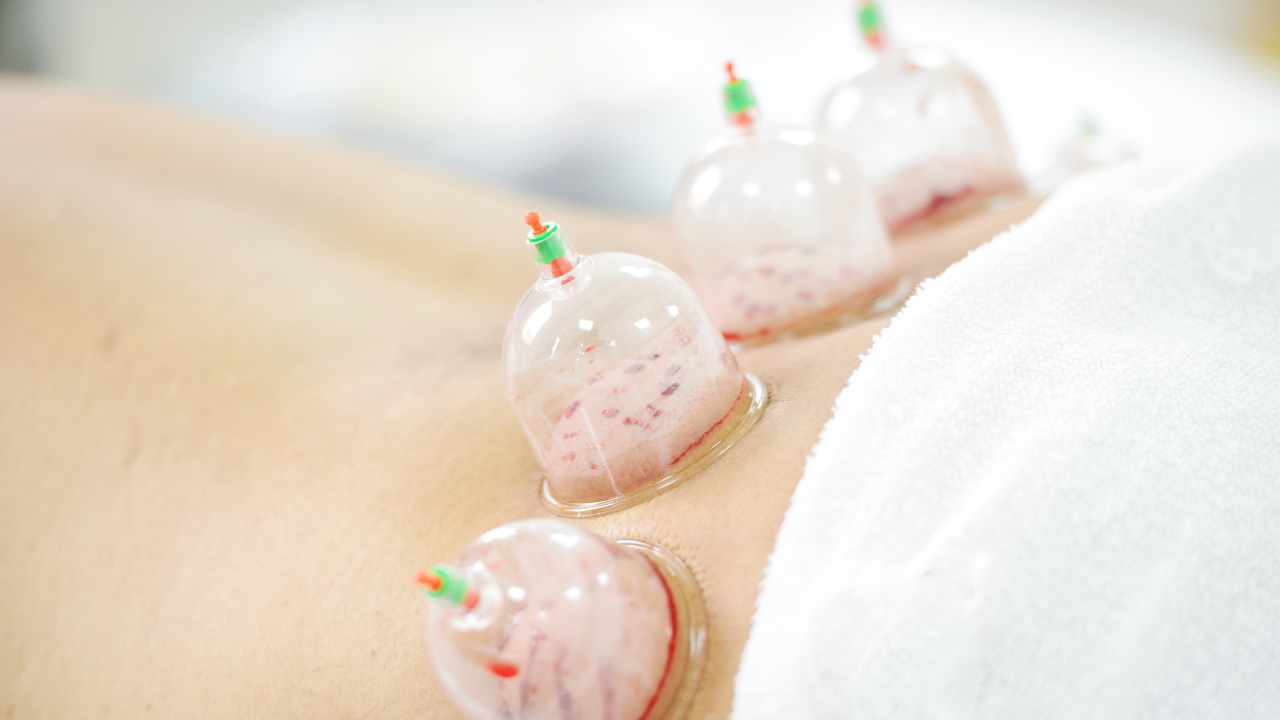 Best Hijama Cupping Therapy Center In Dubai 4025