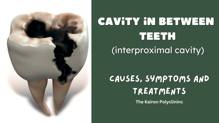 cavity-in-between-teeth-causes-treatment-symptoms