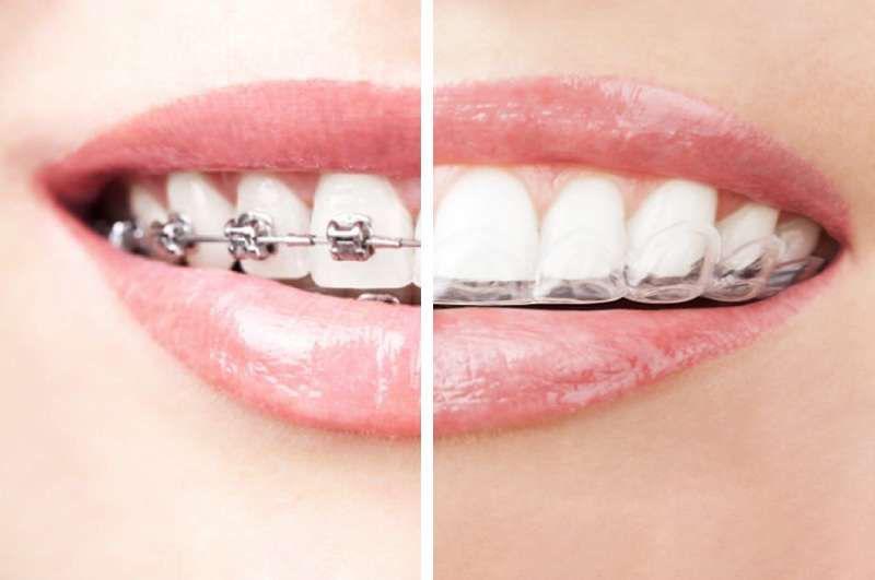Braces vs Invisalign: Which Is Right for You? 1 WhatsApp Image 2025 05 14 at 18.10.23 27fb3986