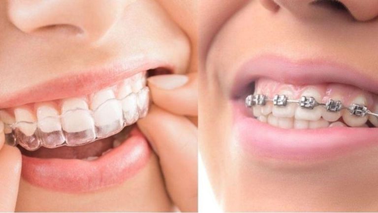 Braces vs Invisalign: Which Is Right for You?